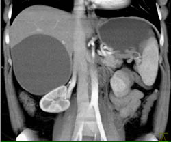 Hepatic Cyst - CTisus CT Scan