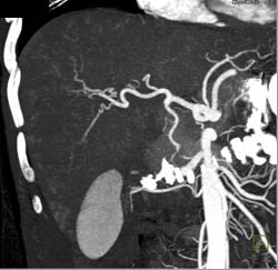 CTA Liver With Small Vascular Liver Metastases - CTisus CT Scan