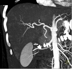 CTA Liver With Small Vascular Liver Metastases - CTisus CT Scan