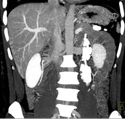 CTA Liver With Small Vascular Liver Metastases - CTisus CT Scan