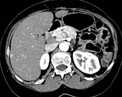 CTA Liver With Small Vascular Liver Metastases - CTisus CT Scan