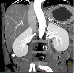 CTA Liver With Small Vascular Liver Metastases - CTisus CT Scan