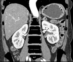 CTA Liver With Small Vascular Liver Metastases - CTisus CT Scan