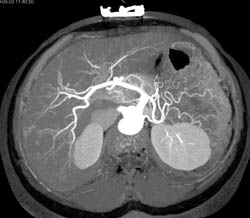 Vascular Liver Lesions Are Isodense on Venous Phase Images - CTisus CT Scan