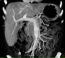 Vascular Liver Lesions Are Isodense on Venous Phase Images - CTisus CT Scan