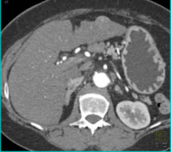 2 Cm Hepatocellular Carcinoma (Hepatoma) Left Lobe of the Liver - CTisus CT Scan