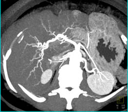 2 Cm Hepatocellular Carcinoma (Hepatoma) Left Lobe of the Liver - CTisus CT Scan