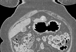 2 Cm Hepatocellular Carcinoma (Hepatoma) Left Lobe of the Liver - CTisus CT Scan