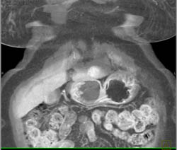 2 Cm Hepatocellular Carcinoma (Hepatoma) Left Lobe of the Liver - CTisus CT Scan