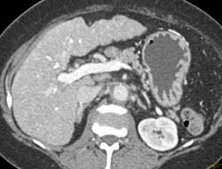 2 Cm Hepatocellular Carcinoma (Hepatoma) Left Lobe of the Liver - CTisus CT Scan