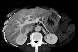 2 Cm Hepatocellular Carcinoma (Hepatoma) Left Lobe of the Liver - CTisus CT Scan