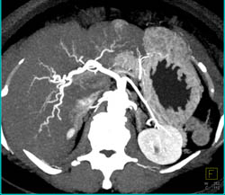 2 Cm Hepatocellular Carcinoma (Hepatoma) Left Lobe of the Liver - CTisus CT Scan