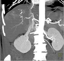 Neovascularity in Hepatocellular Carcinoma (Hepatoma) - CTisus CT Scan