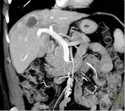 Neovascularity in Hepatocellular Carcinoma (Hepatoma) - CTisus CT Scan