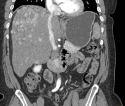 Neovascularity in Hepatocellular Carcinoma (Hepatoma) - CTisus CT Scan