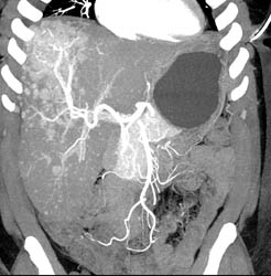 Neovascularity in Hepatocellular Carcinoma (Hepatoma) - CTisus CT Scan