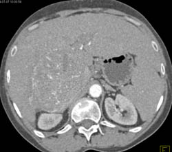 Hepatocellular Carcinoma (Hepatoma) With Neovascularity and Pseudocapsule - CTisus CT Scan