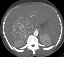 Hepatocellular Carcinoma (Hepatoma) With Neovascularity and Pseudocapsule - CTisus CT Scan