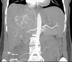 Hepatocellular Carcinoma (Hepatoma) With Neovascularity and Pseudocapsule - CTisus CT Scan