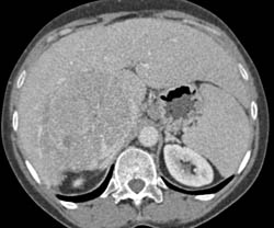 Hepatocellular Carcinoma (Hepatoma) With Neovascularity and Pseudocapsule - CTisus CT Scan