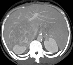 Hepatocellular Carcinoma (Hepatoma) With Neovascularity and Pseudocapsule - CTisus CT Scan