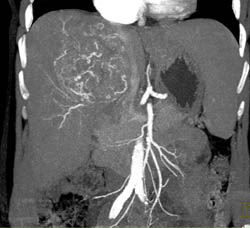 Hepatocellular Carcinoma (Hepatoma) With Neovascularity and Pseudocapsule - CTisus CT Scan