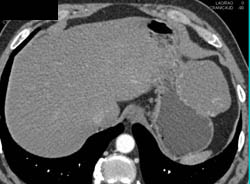 Hepatic Hemangioma Simulates A GIST Tumor of the Stomach- See Full Sequence of Images - CTisus CT Scan