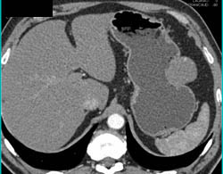 Hepatic Hemangioma Simulates A GIST Tumor of the Stomach- See Full Sequence of Images - CTisus CT Scan