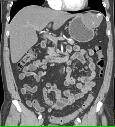 Hepatic Hemangioma Simulates A GIST Tumor of the Stomach- See Full Sequence of Images - CTisus CT Scan