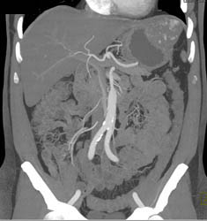 Hepatic Hemangioma Simulates A GIST Tumor of the Stomach- See Full Sequence of Images - CTisus CT Scan