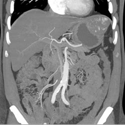 Hepatic Hemangioma Simulates A GIST Tumor of the Stomach- See Full Sequence of Images - CTisus CT Scan