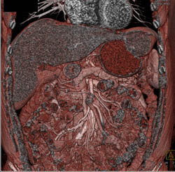 Hepatic Hemangioma Simulates A GIST Tumor of the Stomach- See Full Sequence of Images - CTisus CT Scan