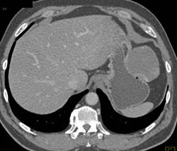 Hepatic Hemangioma Simulates A GIST Tumor of the Stomach- See Full Sequence of Images - CTisus CT Scan