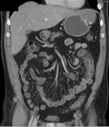 Hepatic Hemangioma Simulates A GIST Tumor of the Stomach- See Full Sequence of Images - CTisus CT Scan