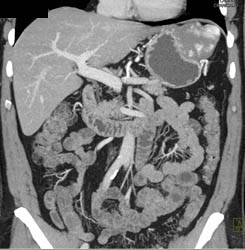 Hepatic Hemangioma Simulates A GIST Tumor of the Stomach- See Full Sequence of Images - CTisus CT Scan