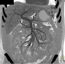 Hepatic Hemangioma Simulates A GIST Tumor of the Stomach- See Full Sequence of Images - CTisus CT Scan