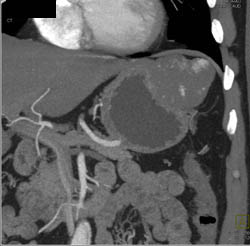 Hepatic Hemangioma Simulates A GIST Tumor of the Stomach- See Full Sequence of Images - CTisus CT Scan