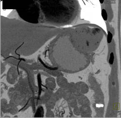 Hepatic Hemangioma Simulates A GIST Tumor of the Stomach- See Full Sequence of Images - CTisus CT Scan