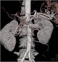 Common Trunk to Superior Mesenteric Artery (SMA) and Celiac Artery - CTisus CT Scan