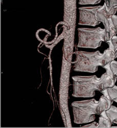 Common Trunk to Superior Mesenteric Artery (SMA) and Celiac Artery - CTisus CT Scan