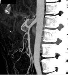 Common Trunk to Superior Mesenteric Artery (SMA) and Celiac Artery - CTisus CT Scan