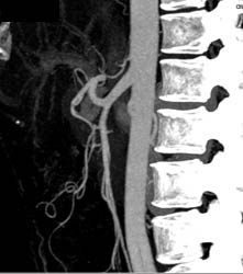 Common Trunk to Superior Mesenteric Artery (SMA) and Celiac Artery - CTisus CT Scan