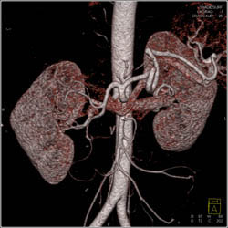 Common Trunk to Superior Mesenteric Artery (SMA) and Celiac Artery - CTisus CT Scan