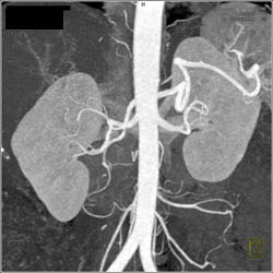 Common Trunk to Superior Mesenteric Artery (SMA) and Celiac Artery - CTisus CT Scan