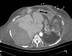 Subcapsular Bleed S/p Trauma - CTisus CT Scan