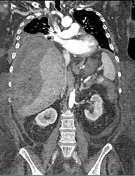 Subcapsular Bleed S/p Trauma - CTisus CT Scan