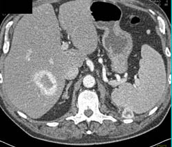 Metastatic Renal Cell Carcinoma to Liver and Peri-splenic Zone- See Arterial and Venous Phase Images - CTisus CT Scan