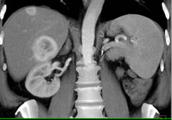 Metastatic Renal Cell Carcinoma to Liver and Peri-splenic Zone- See Arterial and Venous Phase Images - CTisus CT Scan