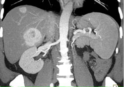 Metastatic Renal Cell Carcinoma to Liver and Peri-splenic Zone- See Arterial and Venous Phase Images - CTisus CT Scan