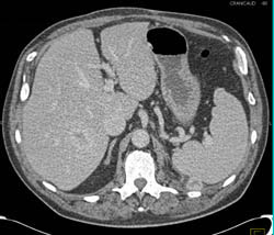 Metastatic Renal Cell Carcinoma to Liver and Peri-splenic Zone- See Arterial and Venous Phase Images - CTisus CT Scan